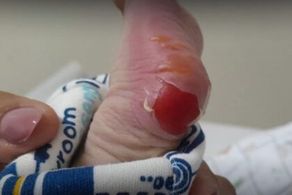 “Fiquei péssima com o ocorrido” afirma secretária após queimadura de segundo grau em bebê durante teste do pezinho