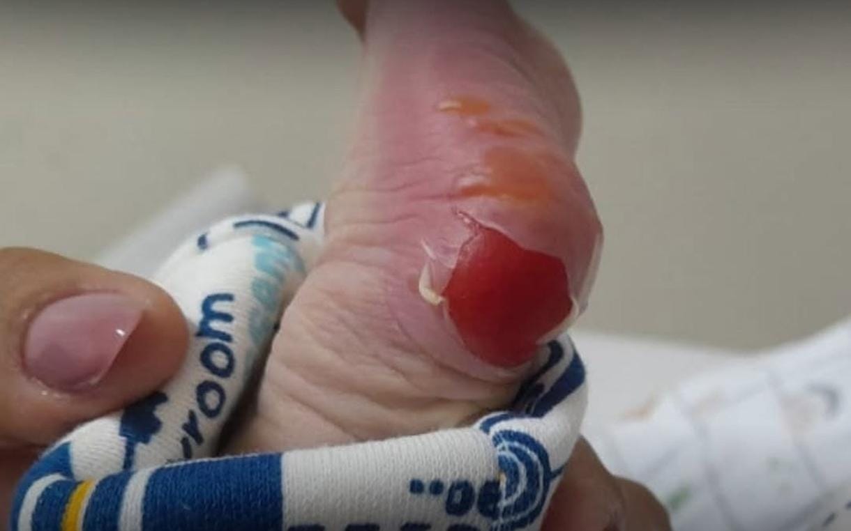 “Fiquei péssima com o ocorrido” afirma secretária após queimadura de segundo grau em bebê durante teste do pezinho